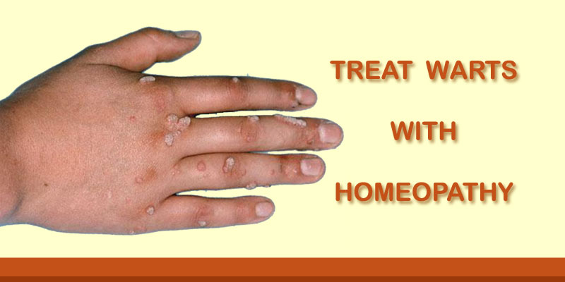 wart treatment in homeopathy